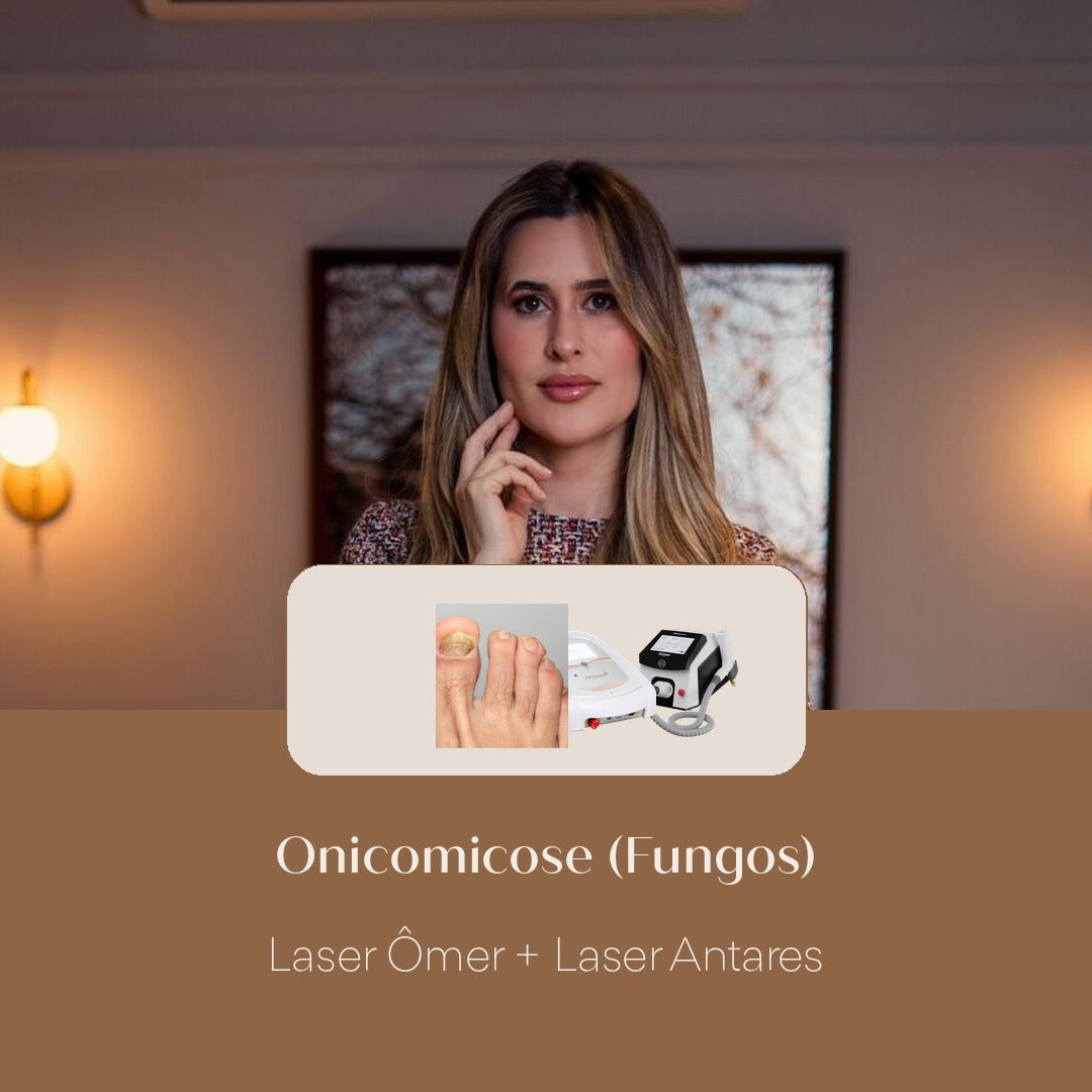 Onicomicose (Fungos) Laser Ômer + Laser Antares