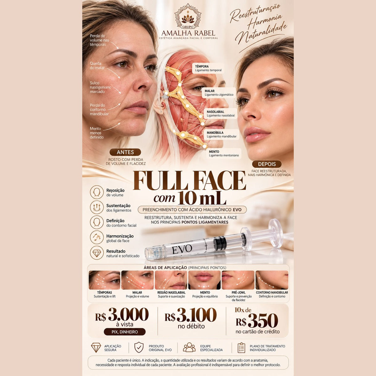 Full Face com 10ml - Preenchimento Ácido Hialurônico EVO