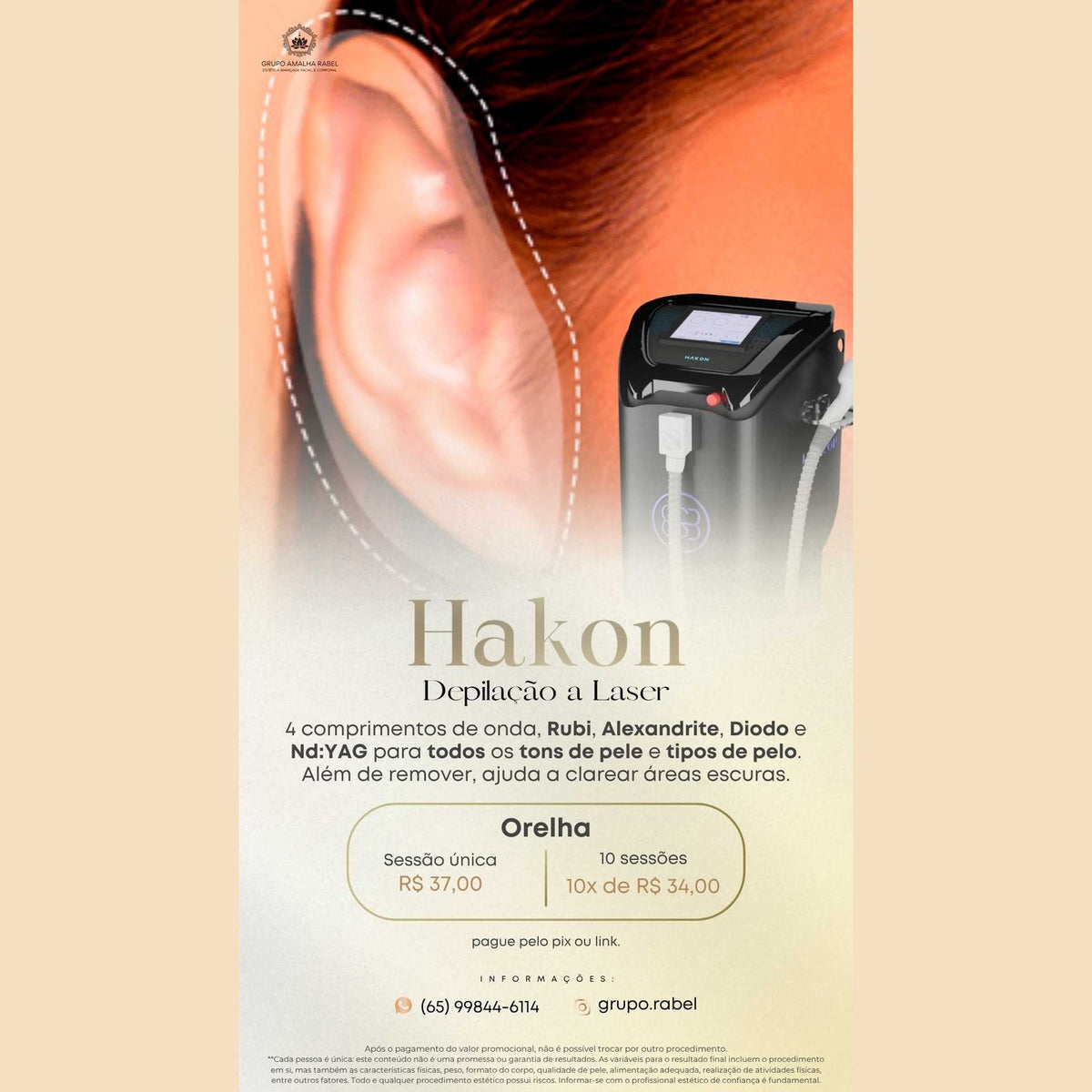 Hakon - Depilação a Laser - Orelha (Sessão única)