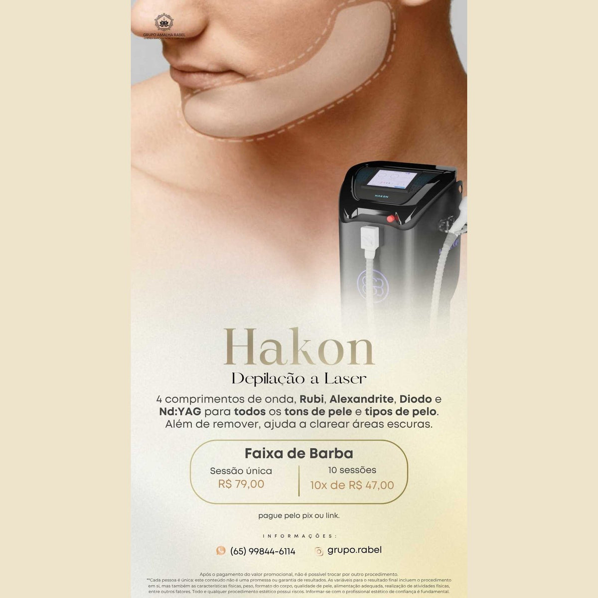 Hakon - Depilação a Laser - Faixa de Barba (Sessão única)