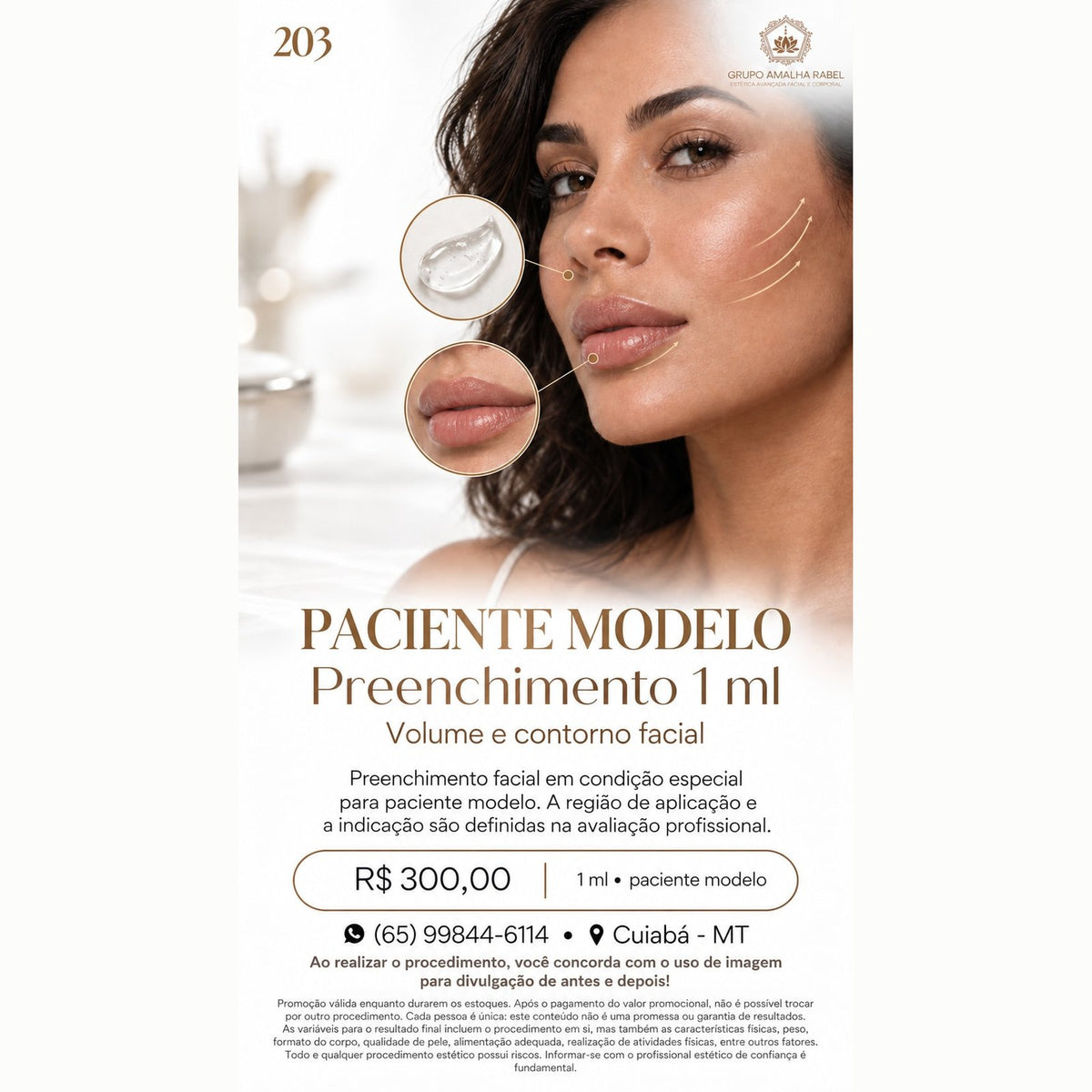 Preenchimento 1 ml - Volume e contorno facial (1 ml)