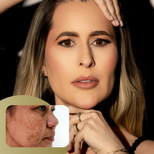 Combo Melasma 4 - 3 sessões de ácido tranexâmico  1 sessão de glutationa  1 sessão de ácido mandélico  1 sessão de kojico  3 sessões de peeling retinoico