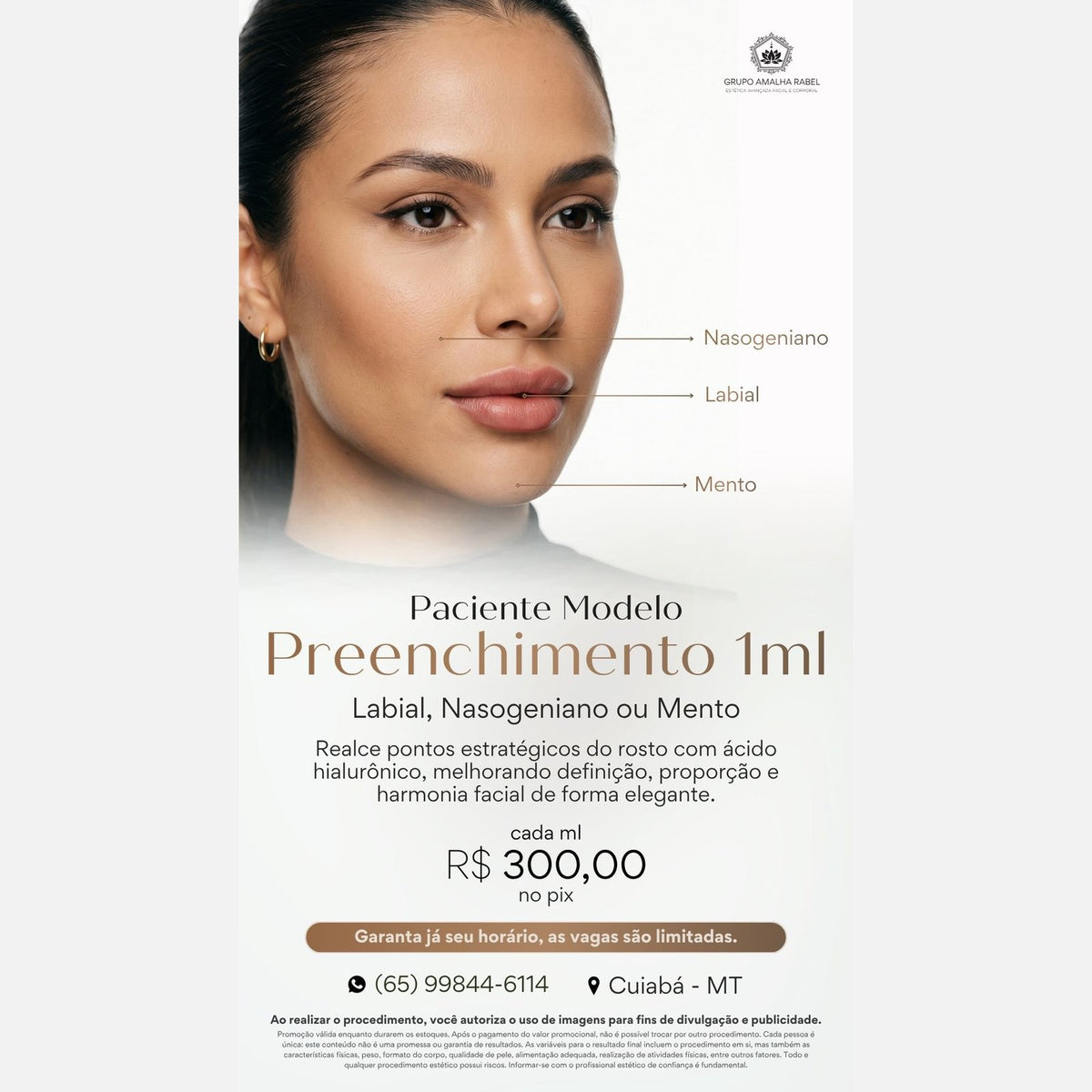 Preenchimento 1ml - Labial, Nasogeniano ou Mento